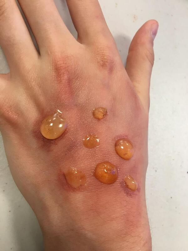 Blisters created with SFX professional makeup